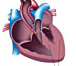 Вторичная кардиомиопатия: что это такое, причина смерти