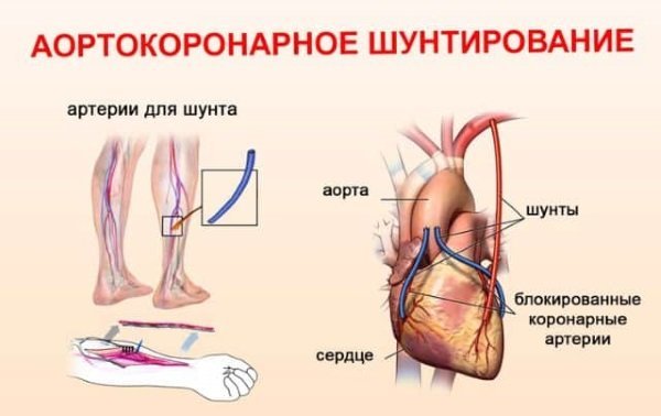Какую операцию на сердце делают при инфаркте миокарда?