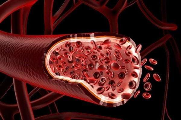 Атеросклероз аорты сердца: что это такое, лечение народными средствами