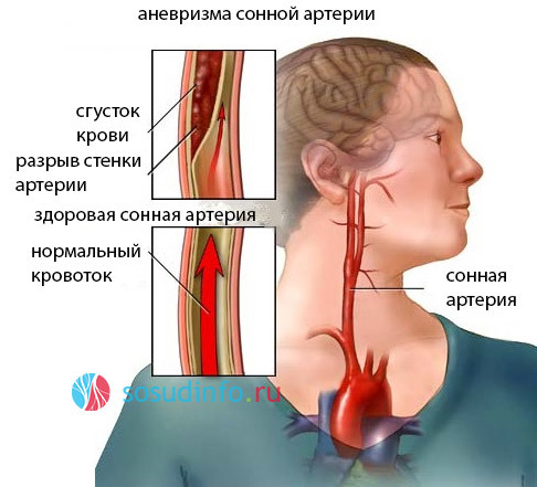 Аневризма сонной артерии шеи: симптомы