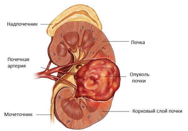 Что такое реноваскулярная (вазоренальная) артериальная гипертензия: особенности лечения