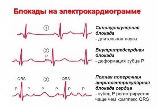 Нарушение проводимости сердца, блокада 1 степени: что это такое простыми словами, симптомы, причины, лечение и экг