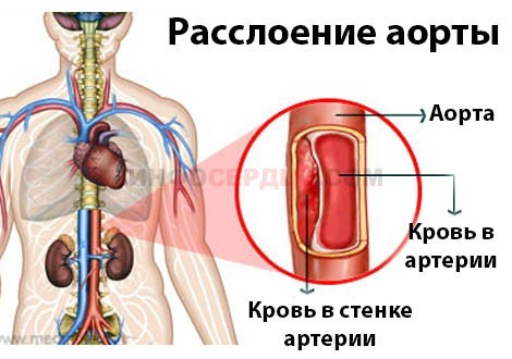 Аневризма грудной части аорты, разорванная смерть: симптомы и диагностика