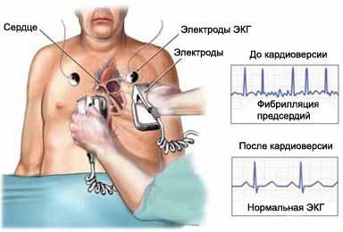 Медикаментозная и электрическая кардиоверсия при мерцательной аритмии и фибрилляции предсердий