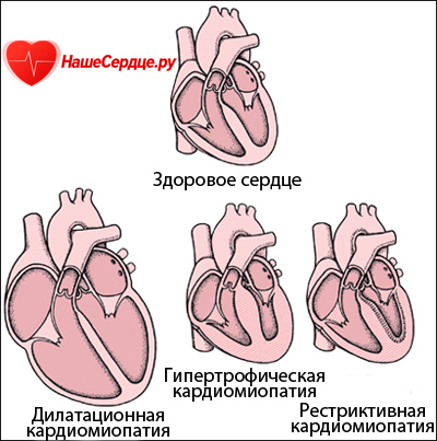Что такое кардиомиопатия, ее проявления, классификация и причины