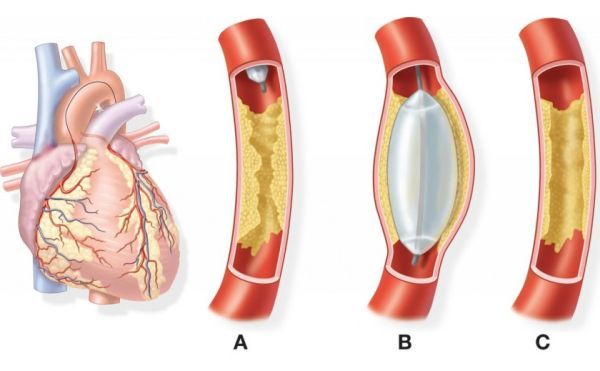 Атеросклеротическая болезнь сердца: что это такое, симптомы поражения, как избавиться от бляшек