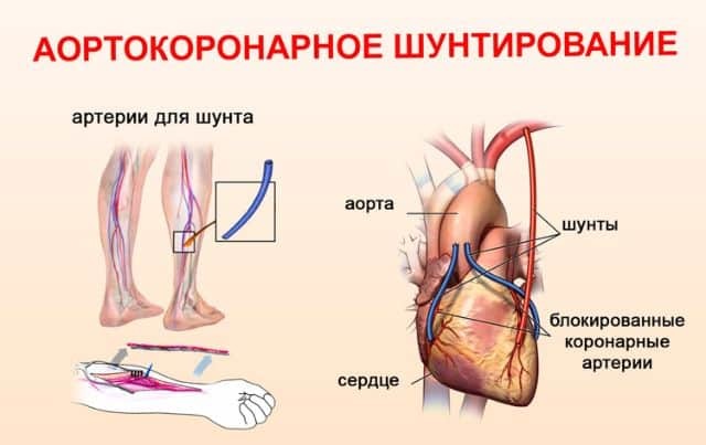 Какую операцию на сердце делают при инфаркте миокарда?