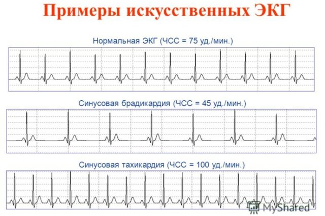 Кардиограмма сердца: как расшифровать ее самостоятельно, пример плохой электрокардиограммы у женщин