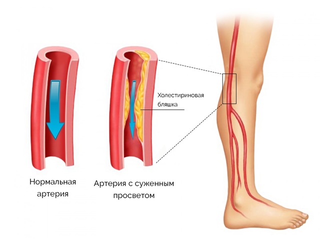 Стенозирующий атеросклреоз: признаки поражения, лечение магистральных артерий нижних конечностей