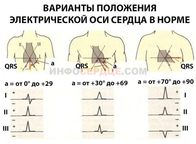 Отклонение электрической оси сердца вправо и вправо, вертикальная позиция у детей: что это такое и что значит