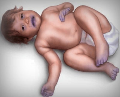 Шумы в сердце у новорожденного ребенка, грудничка: причины