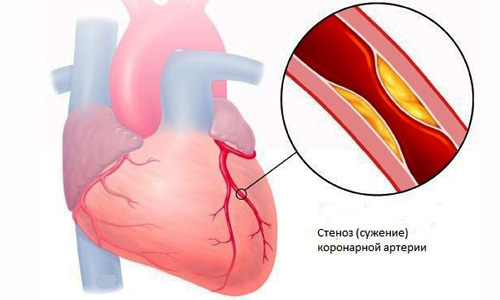 Осложнения артериальной гипертензии и гипертонии