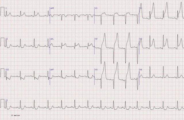 Признаки инфаркта миокрада на ЭКГ