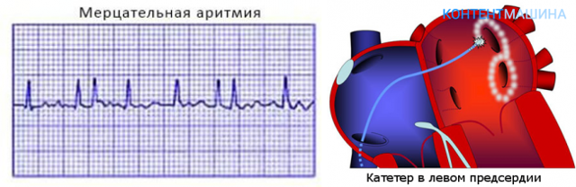 Радиочастотная абляция сердца, ее последствия, особенности реабилитации