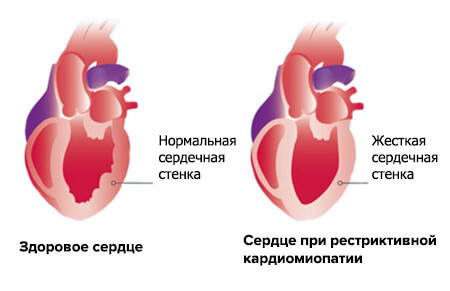 Рестриктивная кардиомиопатия