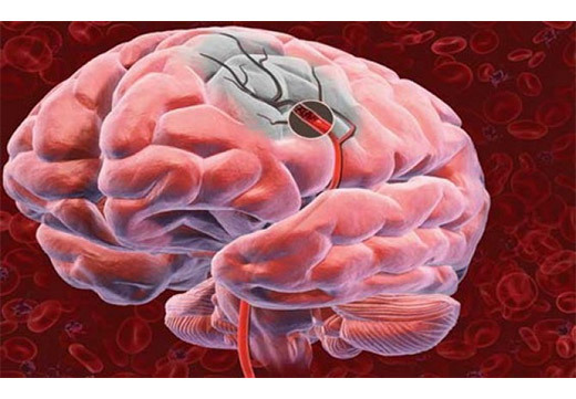 Атеросклероз сосудов головного мозга: симптомы и лечение, причины, чем опасен, диагностика, продолжительность жизни