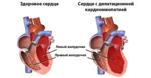 Кардиомегалия у человека: что это, причины болезни, лечение синдрома бычьего сердца