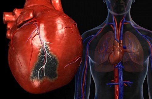 Можно ли заниматься сексом после инфаркта миокарда?