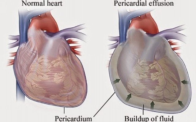 Расширение правого желудочка сердца в поперечнике: что это значит?