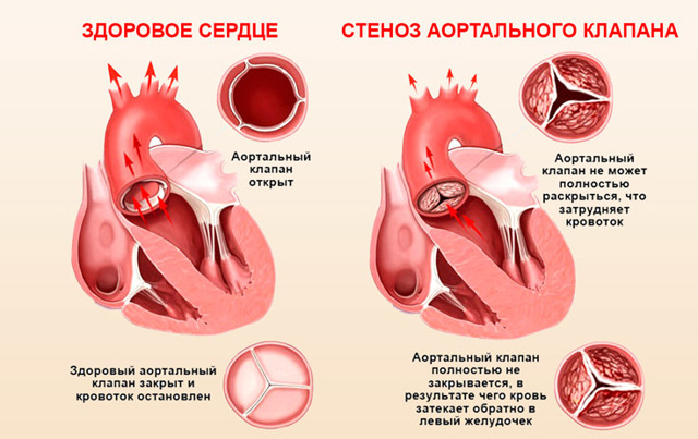 Замена аортального клапана сердца: виды операций, последствия, жизнь после протезирования