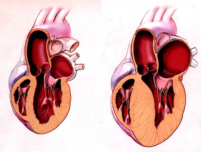 Дилатация полости левого и правого желудочка сердца: что это такое