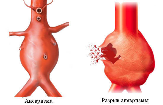 Аневризма аорты сердца: что это такое