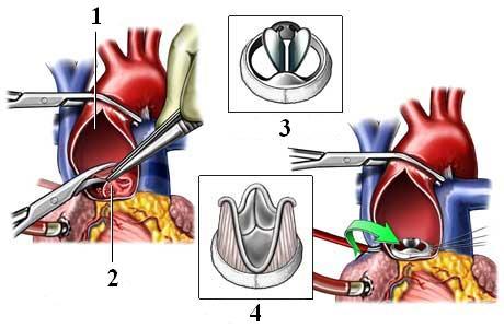 Замена аортального клапана сердца: виды операций, последствия, жизнь после протезирования