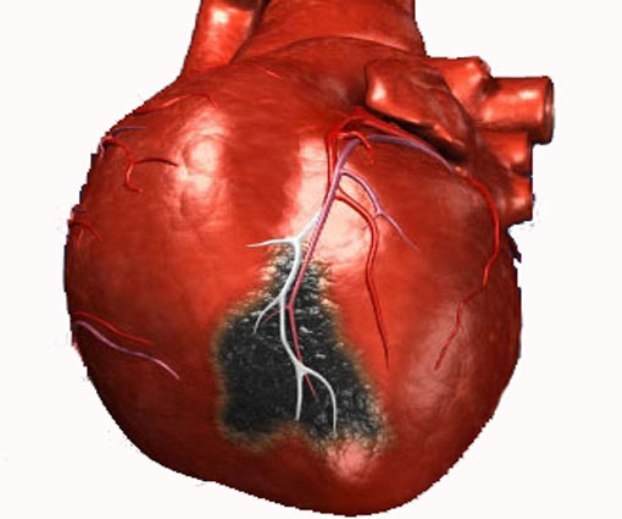 Инфаркт правого желудочка миокарда на ЭКГ