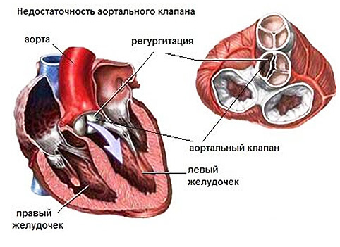 Регургитация аортального клапана 1, 2 степени у ребенка