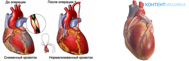 Аортокоронарное шунтирование сосудов сердца: суть операции