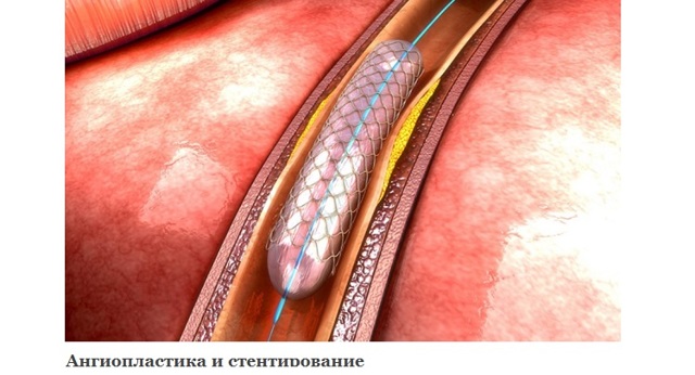 Атеросклероз верхних конечностей: симптомы, лечение сосудов