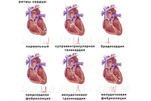 Сбой ритма сердца: причины, лечение, что делать, диагноз и краткая характеристика