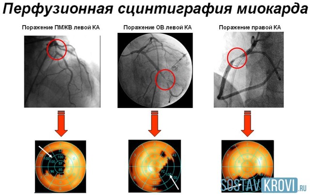 Показания для перфузионной сцинтиграфии миокарда и техника проведения