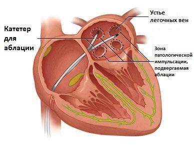 Абляция сердца при мерцательной аритмии: отзывы об РЧА, стоимость операции