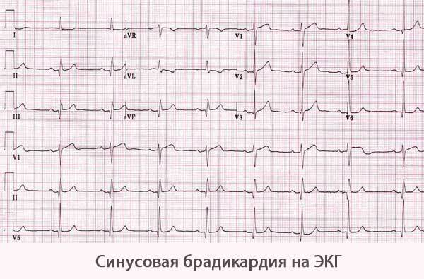 Синусовая брадикардия сердца: что это такое, симптомы и лечение, экг
